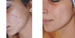 Just Skin | Acne