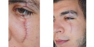Just Skin Litteken Reductie Therapie