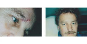 Just Skin Litteken Reductie Therapie