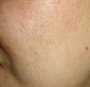 MeLine Hyperpigmentatie JustSkin Amsterdam