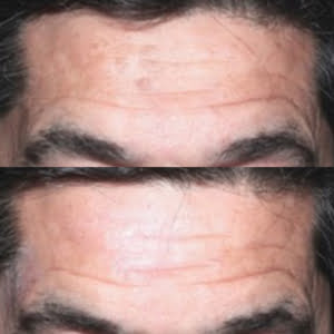 MeLine Hyperpigmentatie JustSkin Amsterdam