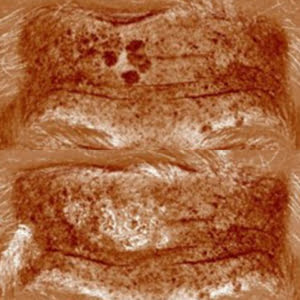 MeLine Hyperpigmentatie JustSkin Amsterdam